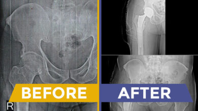 Hip Replacement Surgery
