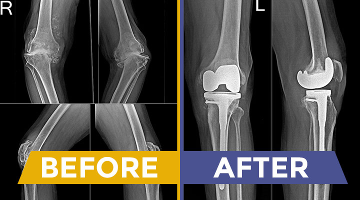 Knee Replacement Surgeon in Kadapa