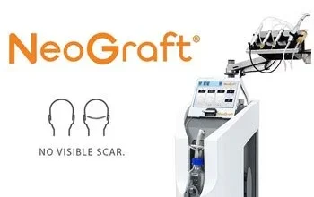 Beard Transplant Chicago