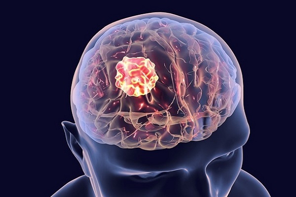 Best Brain Tumor Treatment in India
