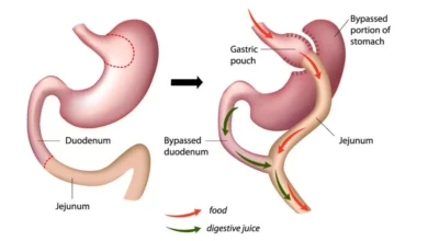 Gastronomic Bypass Surgery in India