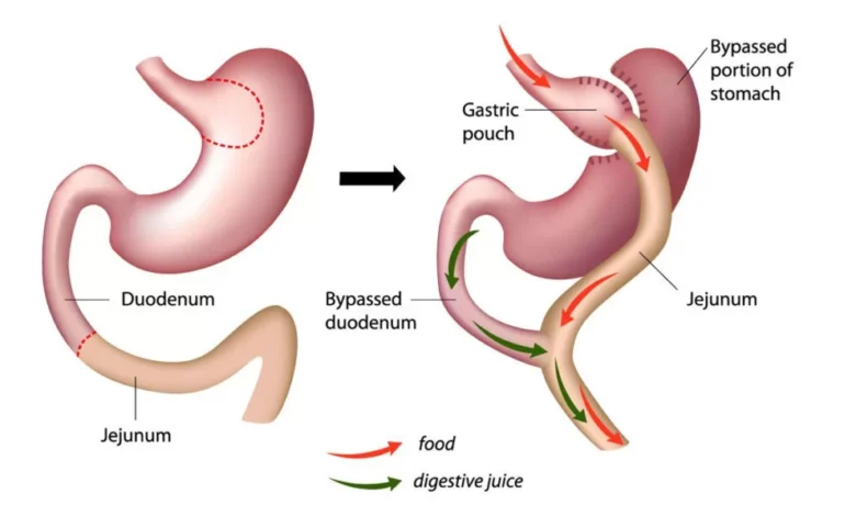 Gastronomic Bypass Surgery in India